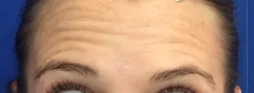 Anti-wrinkle Forehead Treatment